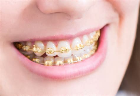 rose gold braces for teeth